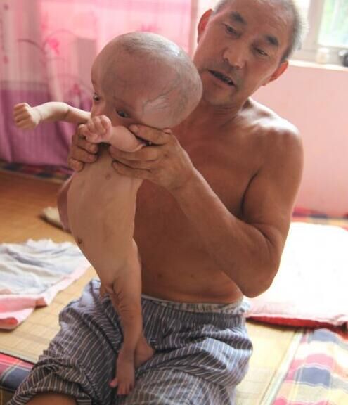 幼儿患绝症 爷爷盼奇迹